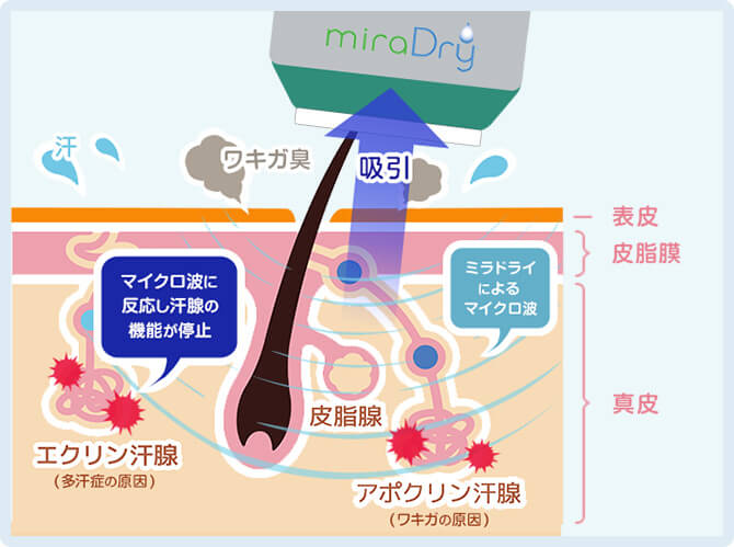 ミラドライの図